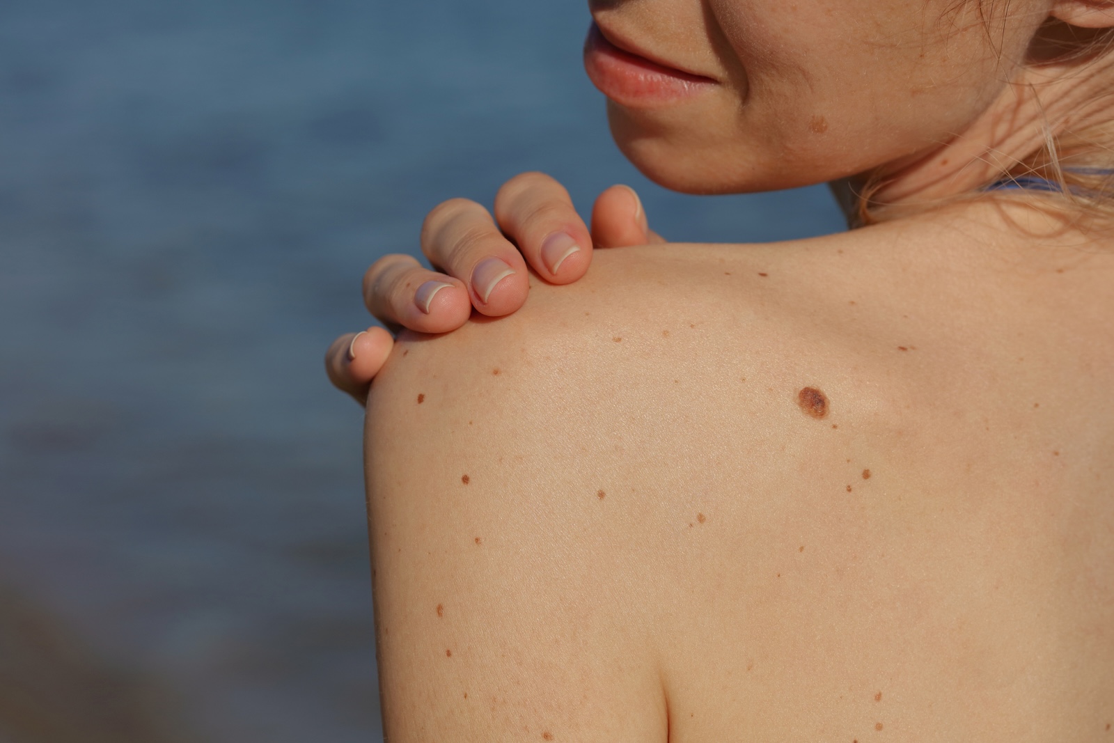 How to Tell if a Mole is Cancerous How to Tell if a Mole is Cancerous banner