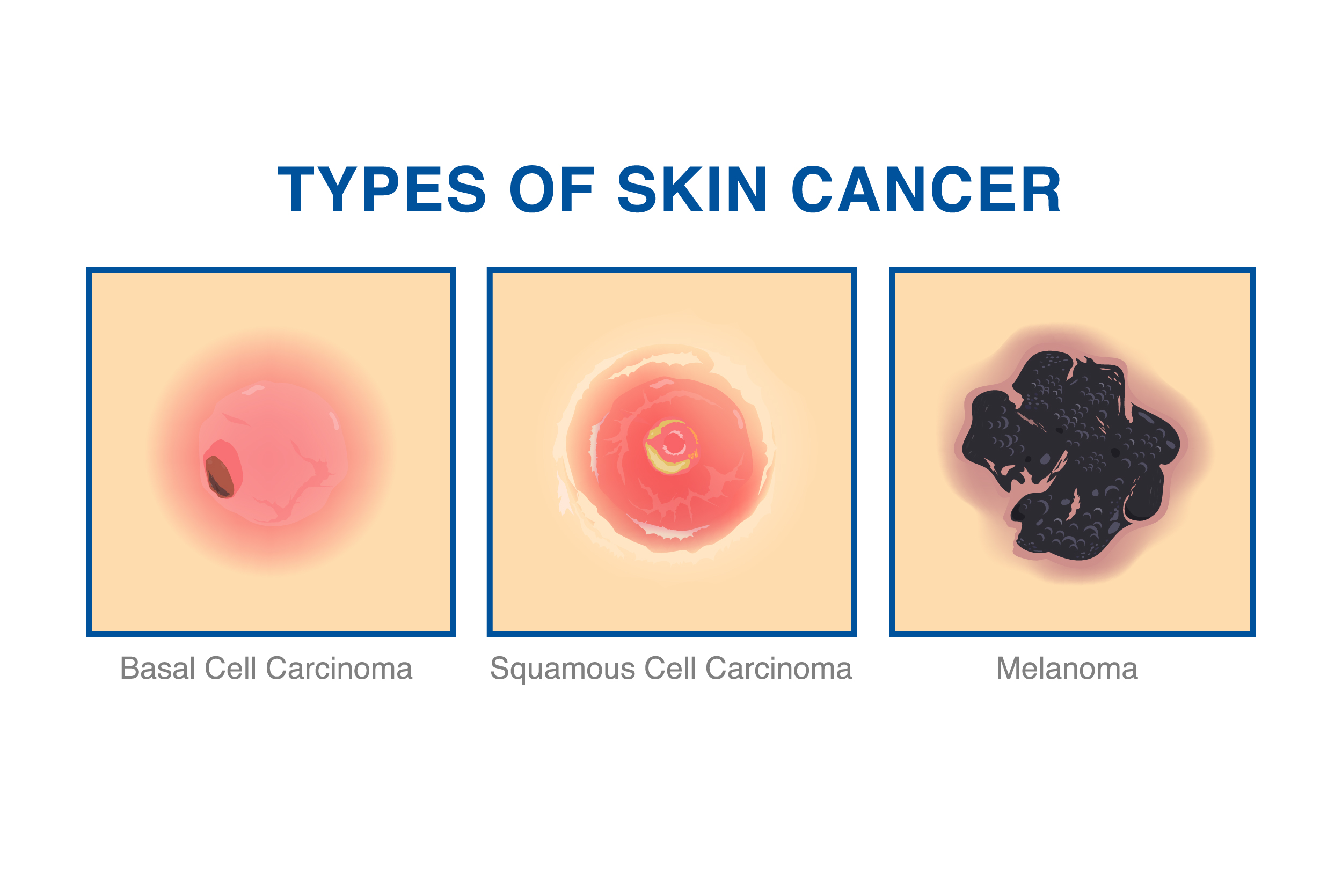 Types of Skin Cancer: BCC, SCC, and Melanoma Explained Types of Skin Cancer iStock 1404462398 Converted