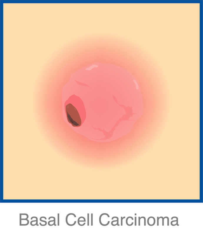 basal img