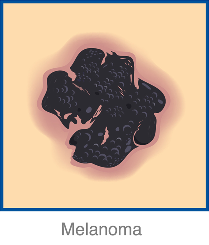 melanoma img