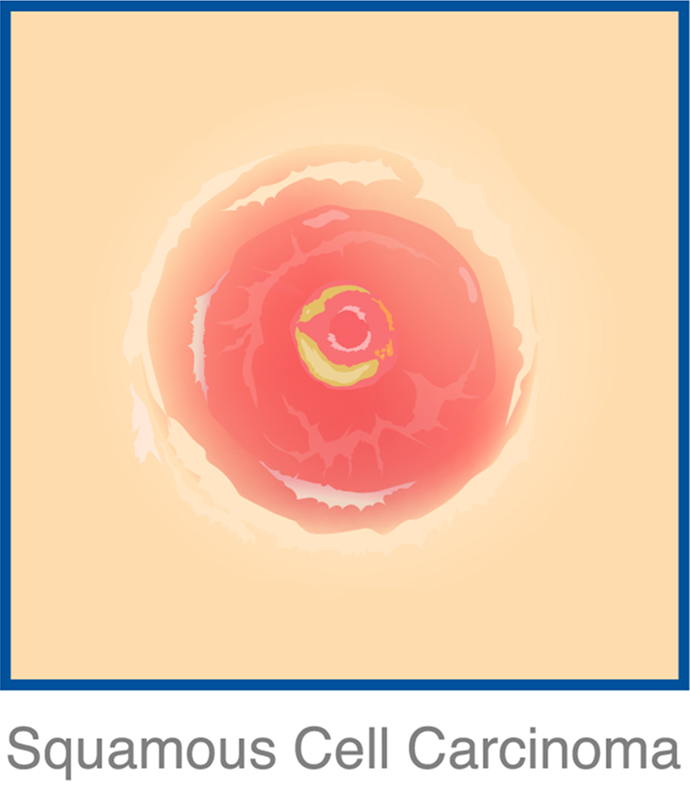 squamous img