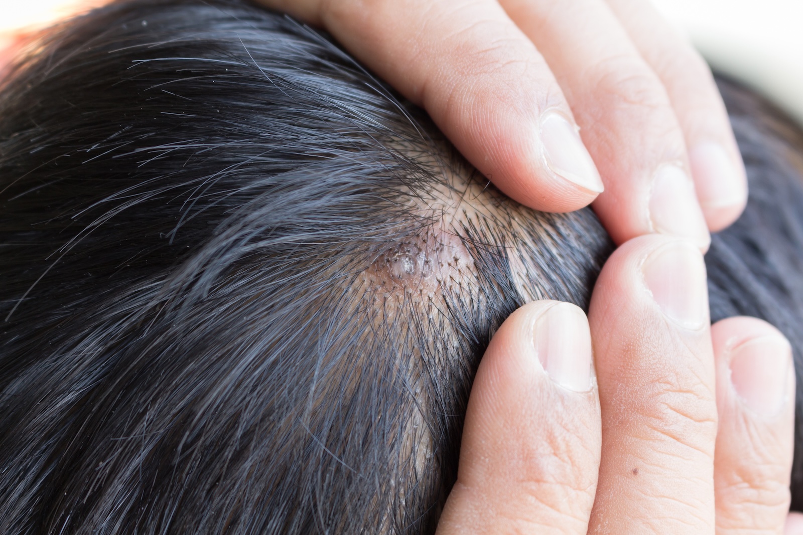 mole scalp